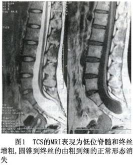 脊髓栓系综合征