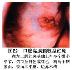增殖性红斑 词条正文在天鹅绒样区域内或外周可见散在的点状或斑块状
