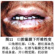 口腔黏膜下纤维化