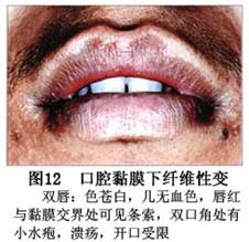 口腔黏膜下纤维化