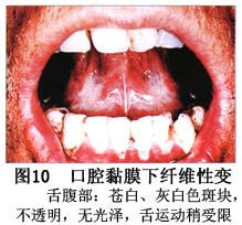 口腔黏膜下纤维化