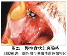 口腔盘状红斑狼疮