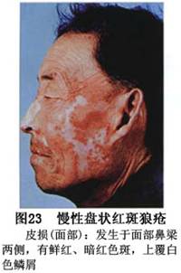 口腔盘状红斑狼疮