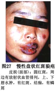 口腔盘状红斑狼疮