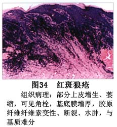 口腔盘状红斑狼疮