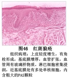 口腔盘状红斑狼疮