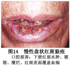 口腔盘状红斑狼疮