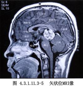 经枕小脑幕入路第三脑室和松果体区肿瘤手术