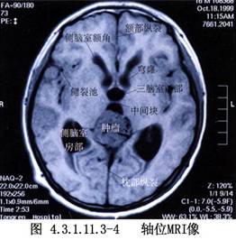 经枕小脑幕入路第三脑室和松果体区肿瘤手术