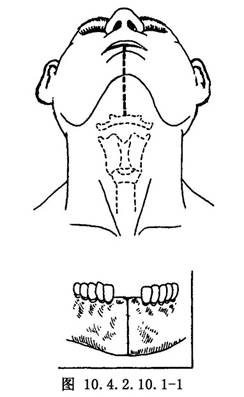 损伤正常组织结构多,故对舌根部体积较小,位置又偏前的肿瘤切除宜取