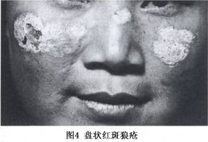 皮肤型红斑狼疮_皮肤型红斑狼疮的临床表现,病理,诊断,西医,中医辨证