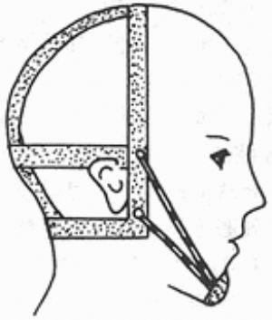 前牙反合 词条正文1.头帽与牵引颏兜矫正装置(图1).