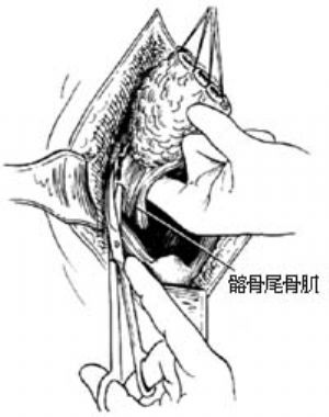 ⑵切断左侧髂骨尾骨肌