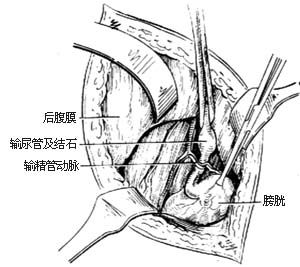 输尿管切开取石术