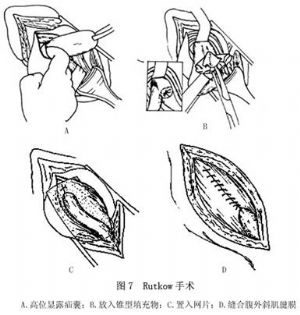 后天性腹股沟斜疝 词条正文 ④rutkow法(疝环充填式无张力疝修补术)