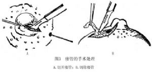 乳腺瘘