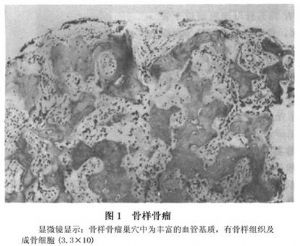 骨样骨瘤