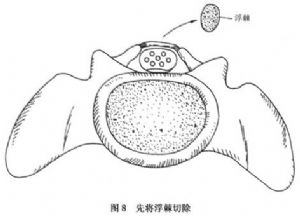 疗效多欠满意,主要是由于浮棘下方达深部的纤维组织多与硬膜囊粘连,此