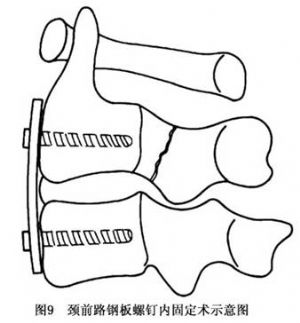 多取后路直视下开放复位,并行后路椎弓根钉内固定术(图7).