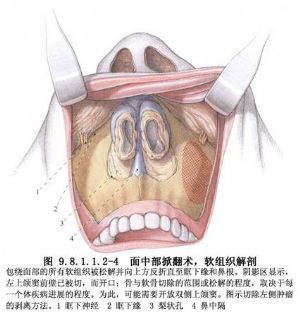 病变累及上颌窦或筛窦时,可行上颌窦前壁及内侧上颌窦切除;切除梨状孔