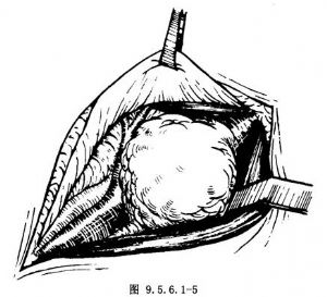 鳃裂囊肿摘除术