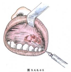 上颌窦根治术