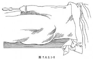 尿道狭窄扩张术