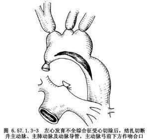婴幼儿心脏移植