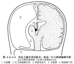 大脑半球实质切除术