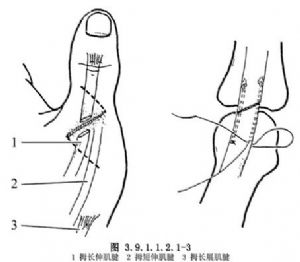 拇长伸肌腱修复术