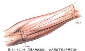 尺,桡骨干骨折畸形愈合矫形术_英文_拼音_什么是尺,桡骨干骨折畸形