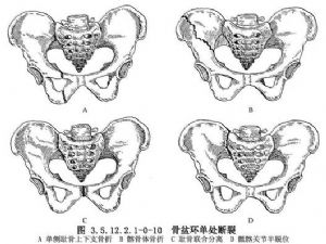 与骶骨骨折和骶髂关节脱位的后方螺钉固定(俯卧位)相关的文献报道