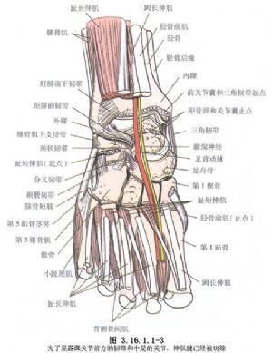 骨水泥型人工踝关节置换