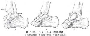 明显移位的距骨颈骨折,尤其在距骨颈骨折并距骨体脱位或距骨全脱位时