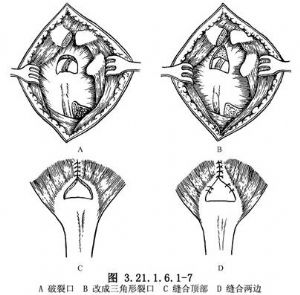 肩袖断裂修复术