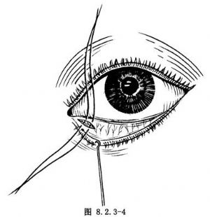 泪点外翻矫正术