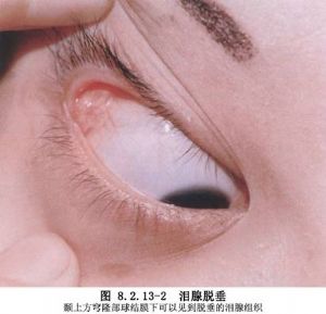 泪腺部分切除术