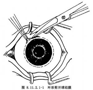单纯眼球摘除术 词条正文11手术步骤 11.11.