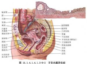 腹腔镜保守性手术治疗盆腔子宫内膜异位症