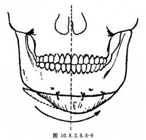 颏偏斜矫正术