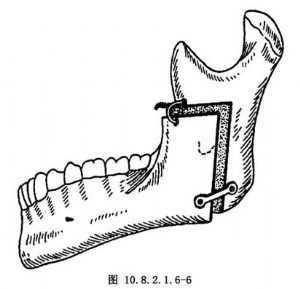 下颌升支倒l型截骨术,c型截骨术