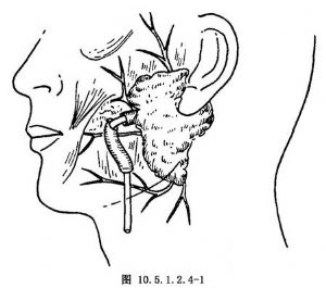 静脉移植腮腺导管修复术