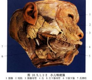腮腺导管涎石摘除术