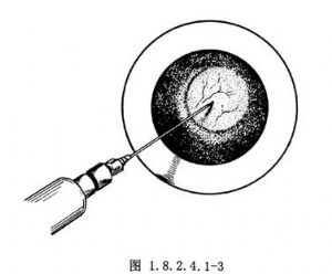 内痔注射疗法