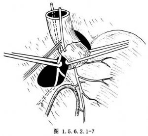 griffith法选择性迷走神经切断术