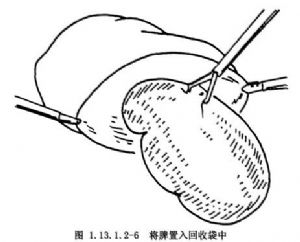 腹腔镜脾切除术