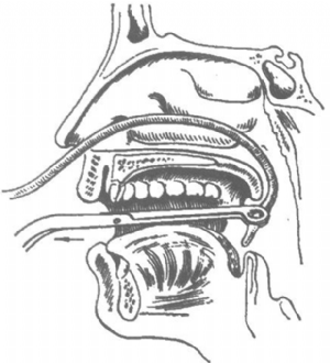 用导尿管由鼻腔插入咽部用海绵钳将其一端引出口外