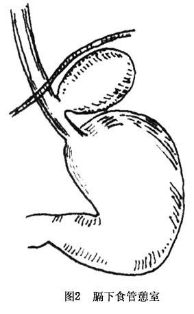 膈下食管憩室_膈下食管憩室的病因病机,临床表现,诊断,治疗_医学百科