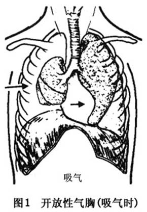 2循环障碍胸膜腔内负压消失影响静脉回流,纵隔扑动引起腔静脉和右心房