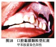 10口腔红斑的临床表现